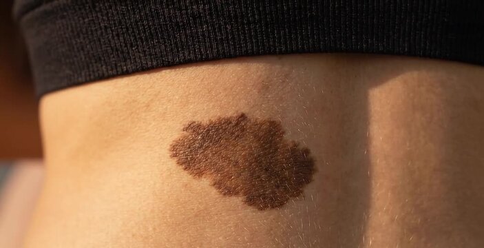 Macro Close Up of Large Brown Congenital Melanocytic Nevus Birthmark on Woman Back