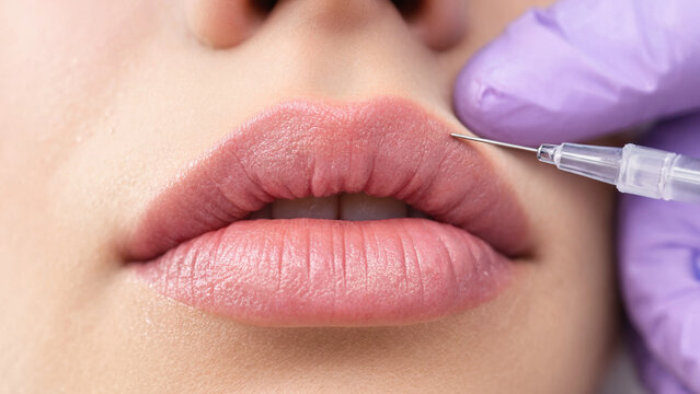 Lip filler injection in personalized aesthetic medicine, hyaluronic acid treatment safety for autoimmune and inflammatory disease patients in remission clinical planning