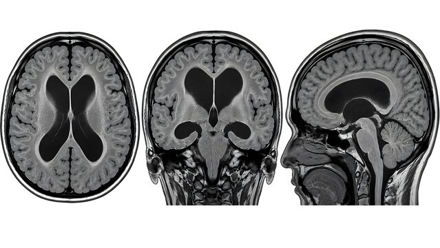 Hydrocephalus Brain MRI Showing Ventriculomegaly in Axial Coronal and Sagittal Views