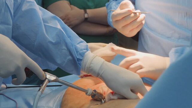 Surgical Team Hands Operating with Laparoscopic Suction Instrument and Scalpel Close Up