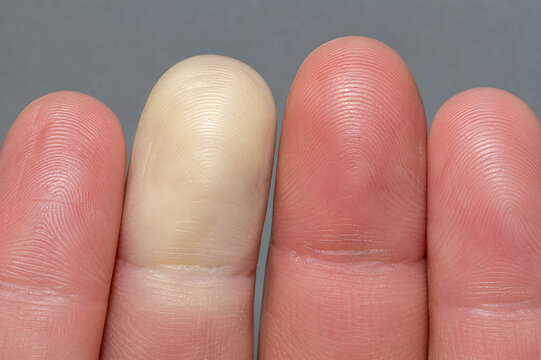 Fingertips with Red White and Purple Color Changes for Circulation Assessment, Raynaud Phenomenon and Vascular Health Examination Vector