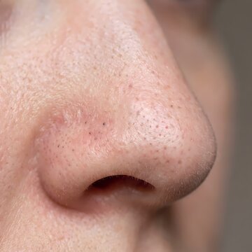 Macro shot of human nose skin featuring visible blackheads and enlarged clogged pores for dermatological skincare analysis