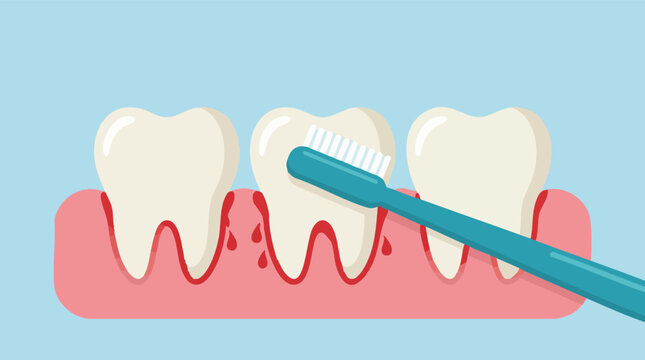 Illustration of teeth being brushed, showing bleeding gums and gum disease