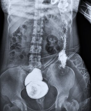 Barium Swallow Fluoroscopy X-Ray Showing Contrast Filling Left Colon and Rectum