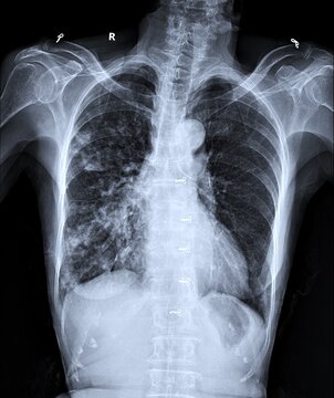 Chest Radiograph Displaying Right Lung Infiltrate and Sternal Closure Sutures