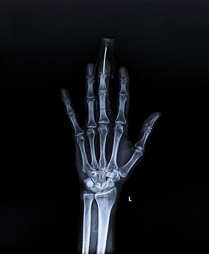 PA View Hand X-Ray Showing Finger Fracture Pin Fixation and Protective Splint