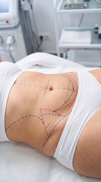 Close up of woman abdomen with surgical markings for cosmetic procedure, lying on medical bed in clinic. Plastic surgery, liposuction, aesthetic medicine.