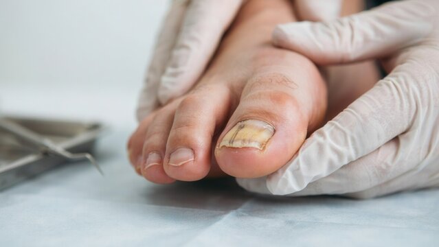 Podiatrist wearing gloves examining discolored infected toenail in medical clinic with foot care nail fungus foot health medical tools health check medical exam doctor hand podiatrist podiatry
