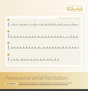 Paroxysmal atrial fibrillation is often triggered by premature atrial contractions; it can occur in isolation or in association with sick sinus syndrome.
