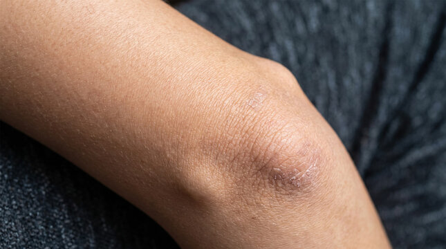 Close up of dry cracked and rough skin on human elbow joint