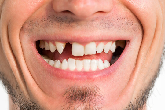 missing tooth close-up. Dental surgery and implantation. Adult man with upper front tooth removed on white background