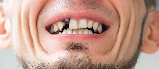 Portrait of a adult male with a missing tooth and stitches on gum. Dental surgery and implantation. Bone grafting for a dental implant. Dental problems close-up © alexkoral