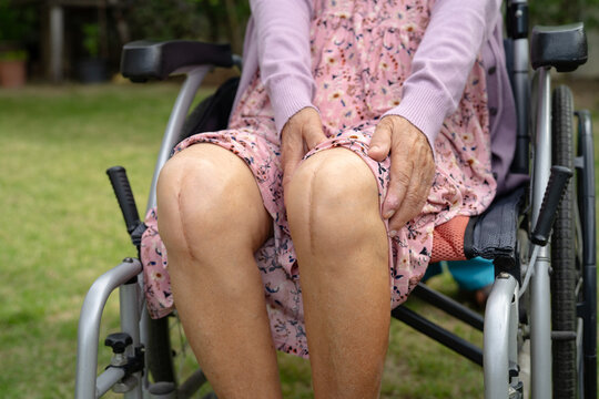 Asian elderly woman patient show her scars surgical total knee joint replacement Suture wound surgery arthroplasty on bed in nursing hospital ward, healthy strong medical concept.