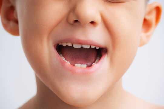Child with missing baby teeth during the natural transition to permanent teeth. Pediatric dentistry and dental health concept, close-up on a white background