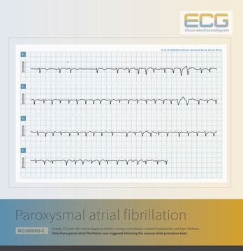 Paroxysmal atrial fibrillation is often triggered by premature atrial contractions; it can occur in isolation or in association with sick sinus syndrome.
