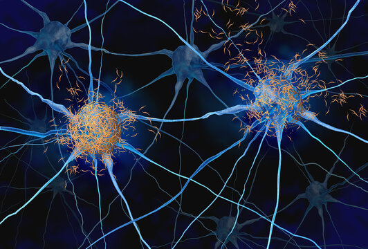 Toxic tau oligomers and neurofibrillary tangles are abnormal accumulations of tau proteins in brain cells that disrupt neuronal function and contribute to the neurodegeneration associated