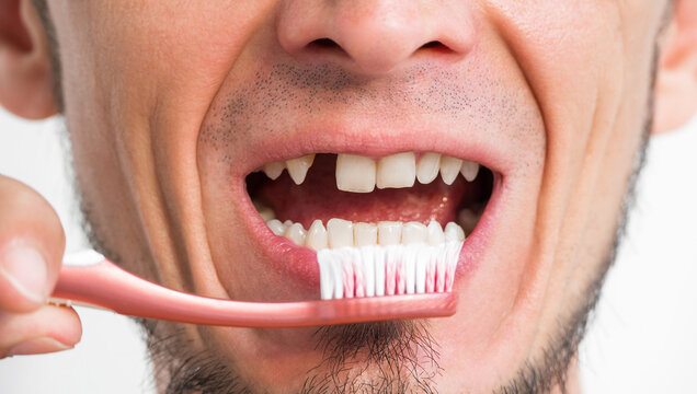 Portrait of a man with a missing tooth and toothbrush close-up. Dental surgery and implantation. The upper front tooth was removed. Dental problems