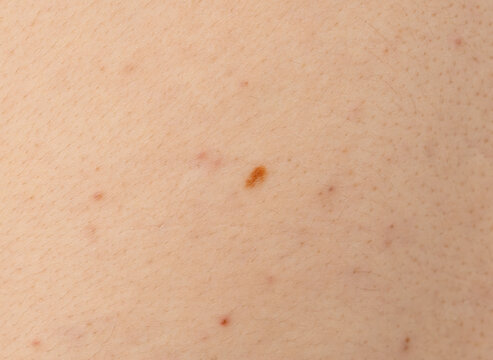 Skin mole closeup. Macro photo of blemish similar to melanoma
