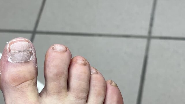 Close-up of patient's toes with installed toenail correction system