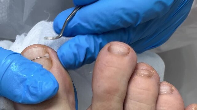 Podiatrist securing correction system component on big toe