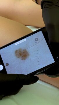 Skin cancer screening with digital dermoscopy, dermatologist examining a mole using a dermatoscope during a professional skin examination