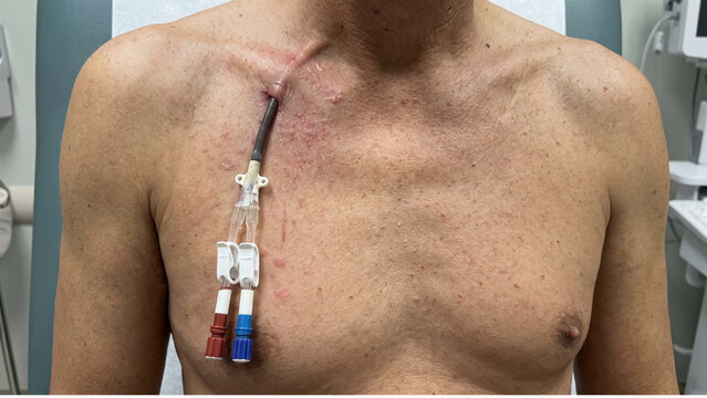 Patient chest displaying a central venous dialysis catheter inserted near the collarbone in a clinical hospital setting.