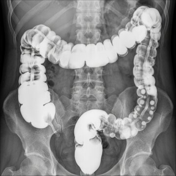 Detailed Medical X-Ray Imaging Of The Human Colon And Rectum