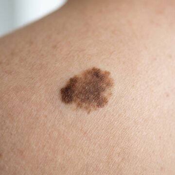 Close-up Of Human Skin With A Pigmented Mole Detailed View