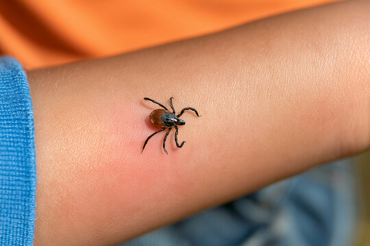 Tick On Child Forearm
