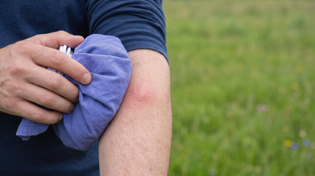 Man holding ice pack on insect sting for first aid outdoors