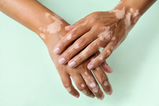Vitiligo skin pigmentation on hands and arms