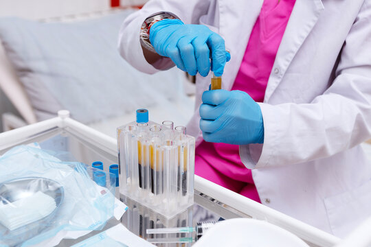 Blood plasma in tubes. Chemistry laboratory. Regenerative medicine. Non-surgical procedures. Lab technician holding test tube of blood sample after being centrifuged. Blood taken from patient