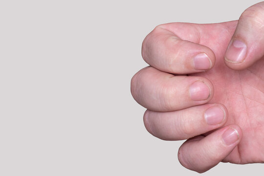 Close-up of short dirty nails, caucasian male hand. Problematic nails, untreated natural nails, male manicure