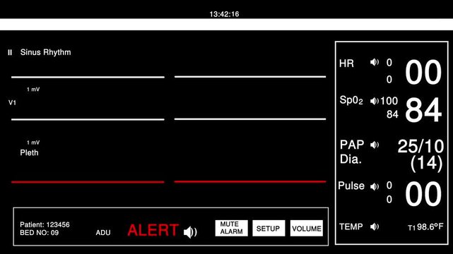 Digital hospital patient heart monitor screen showing flatline sinus rhythm and medical alert status with vital signs numbers like heart rate and oxygen levels in a critical care room setting