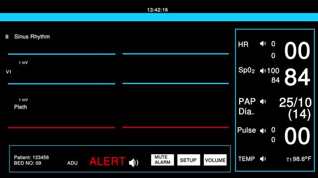 Medical patient monitor screen showing vital signs with flat lines and alert warning in a hospital room setting with dark interface and digital health data numbers displayed for clinical analysis