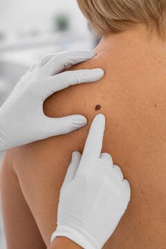 Doctor examining suspicious mole on woman&rsquo;s back during skin cancer screening in clinic