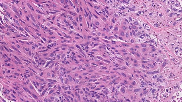 Pathology visualization of sarcoma spindle-shaped cells with elongated nuclei and abundant cytoplasm surrounded by normal host tissue architecture