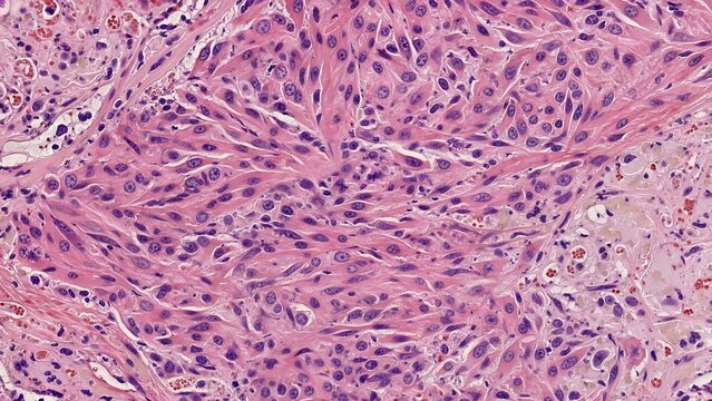 Microscopic render of osteosarcoma or leiomyosarcoma featuring elongated nuclei and spindle-shaped cells in fascicular patterns amid surrounding tissue