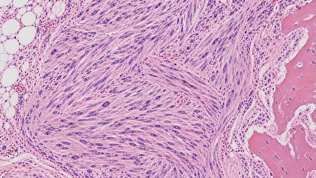 Detailed histology view of sarcoma tumor cells showing characteristic spindle shapes arranged in a fascicular pattern with abundant cytoplasm
