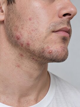Close Up of Adult Man With Inflammatory Acne on Jawline and Chin