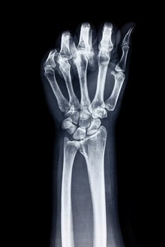 Arm and Wrist medical image for breaks and fractures
