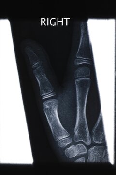 Finger x-ray image