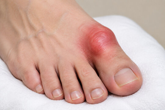 Swollen big toe joint on white cushion, gout and inflammation concept