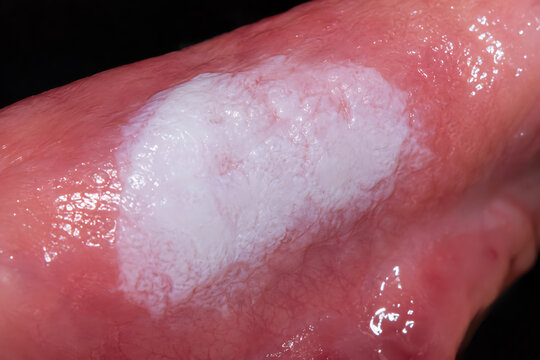 White Patch on Tongue Close Up Showing Oral Mucosal Discoloration for Dental Examination, Oral Health, Dermatology and Medical Diagnosis