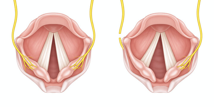 Intact and Interrupted Laryngeal Nerve Vocal Fold Comparison