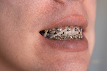 Close up of teeth with metal braces and orthodontic elastics inside an open mouth. Elastic bands help correct bite alignment during orthodontic treatment © Renata