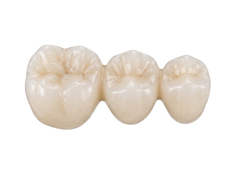 Dental bridge prosthesis photo featuring three ceramic artificial teeth isolated on transparent background