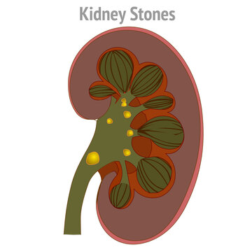 Kidney stones are hard objects made of minerals and salts in urine. Anatomy view of the disease, cross section. Not AI, draw. Illustration vector	