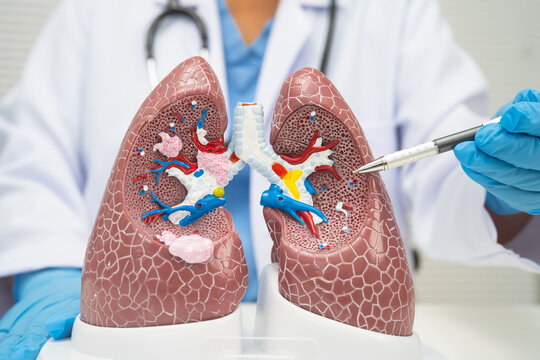 Pneumonia, lung cancer, Asian doctor with human lung model.