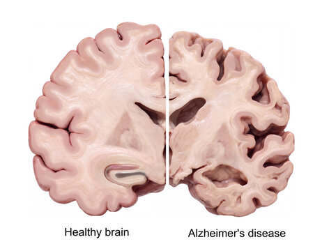 Healthy Brain vs Alzheimer's Disease. Structural Comparison of normal brain half and alzheimers pathology. Cross section of brain isolated on white background  Medical visualization,